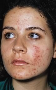 acneea unii tineri fata plina cosuri iar altii fata curata? sunt varsta care asteapta resemnare